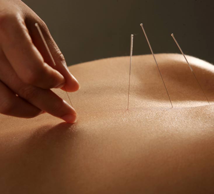 Dry Needling, Akupunktur, Osteopathie Christiane Kopp